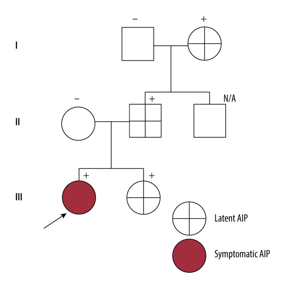 Pedigree of the proband family, arrow indicates our patient, positive (+) indicates the persons who carries Arg173Trp variant, negative (-) indicates persons who have a wild type, grey color indicates symptomatic acute intermittent porphyria (AIP), and cross symbol indicates latent AIP.