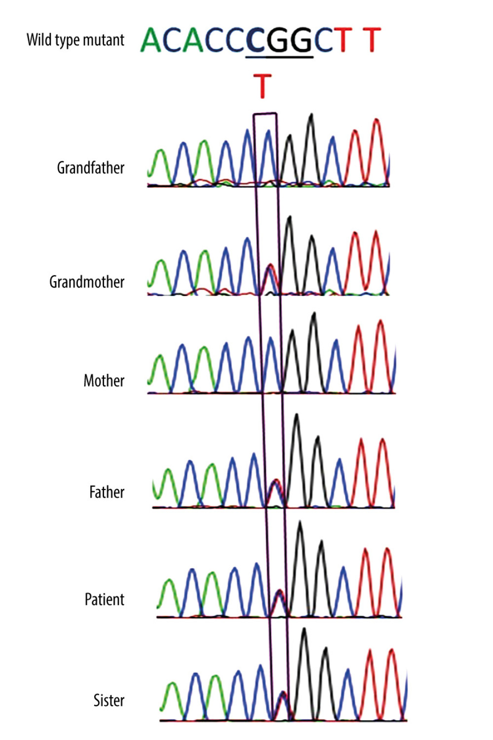Chromatograms show a heterozygous missense pathogenic variant c.517C>T in HMBS in our patient, her father, paternal grandmother, and sister.