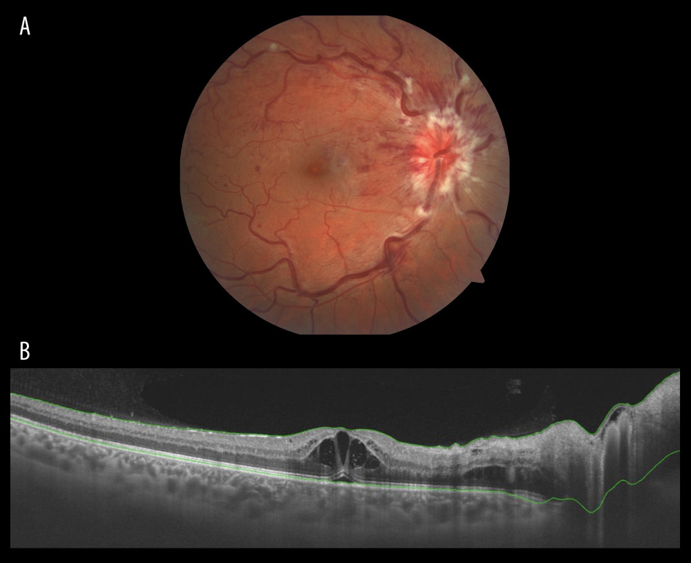 (A) Color fundus photography of the right eye after the onset of symptoms. Visible tortuosity and dilatation of all branches of central retinal vein with dot, blot, and flame hemorrhages, numerous cotton-wool spots, mild disc, and macular edema. (B) Swept source optical coherence tomography of the right eye showing cystoid macular edema before intravitreal injection of ranibizumab.