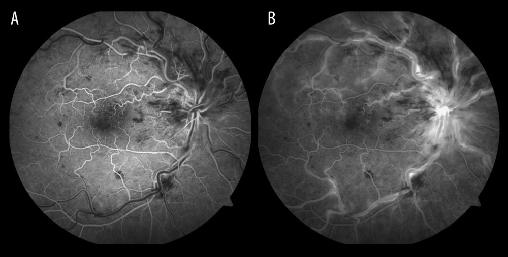 Fluorescein angiogram of the right eye: (A) the arteriovenous phase and (B) the late phase showing masking by hemorrhages and staining of vessel walls with good capillary perfusion.