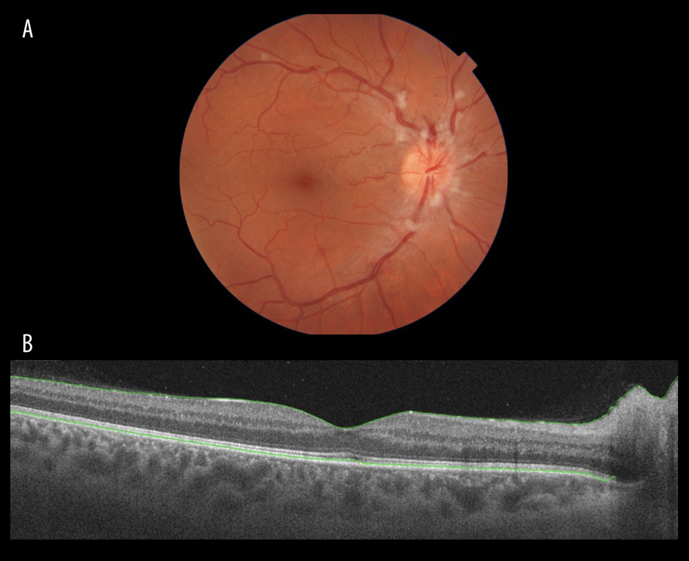 (A) Color fundus photography of the right eye 2 weeks after intravitreal injection of ranibizumab. Significant reduction of vascular changes, hemorrhages, and cotton-wool spots. No macular and disc edema was visualized. (B) Swept source optical coherence tomography of the right eye 2 weeks after intravitreal injection of ranibizumab.