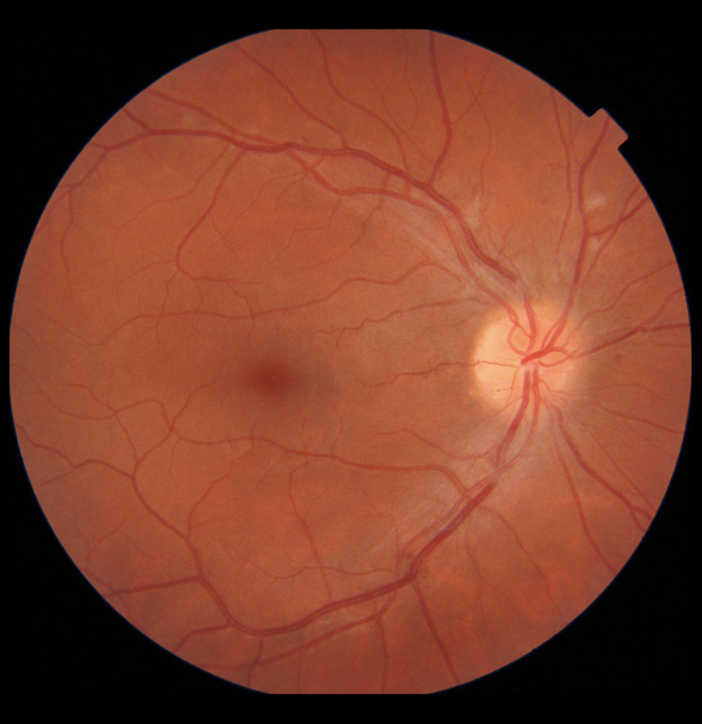 Color fundus photography of the right eye 2 months after intravitreal injection of ranibizumab. A small amount of cotton-wool spots remained.