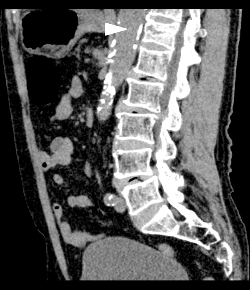 Sagittal section of abdominal computed tomography performed on the day the patient developed prominent abdominal pain, 2 days after his fall, showing a compression fracture in the Th12 vertebra.