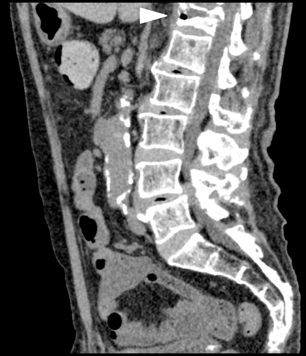 0Sagittal section of abdominal computed tomography (CT) performed after the patient was admitted for diagnostic evaluation, 93 days after his fall. The vertebral compression fracture has progressed since the previous abdominal CT scan 3 months previously.