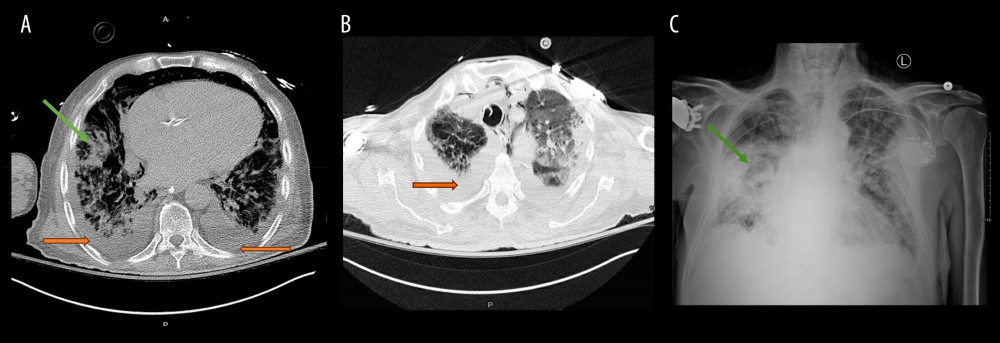 (A, B) Computed tomography of chest done on day 3 of admission showing diffuse infiltrates consistent with acute respiratory distress syndrome (green arrow) and small bilateral pleural effusions (orange arrow). (C) Multifocal airspace opacity, consistent with pneumonia, is shown.