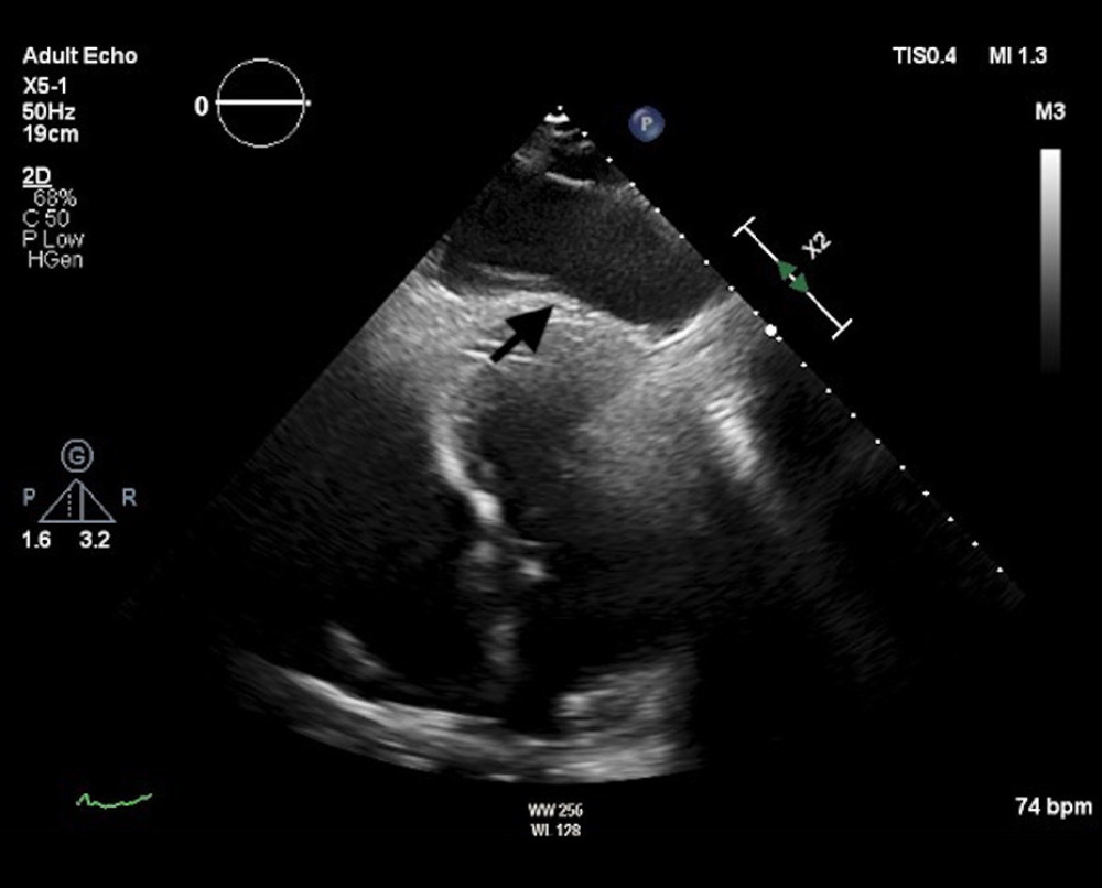 Transthoracic echocardiography showing a large cyst-like structure over the apex of the left ventricle (cyst shown by arrow).
