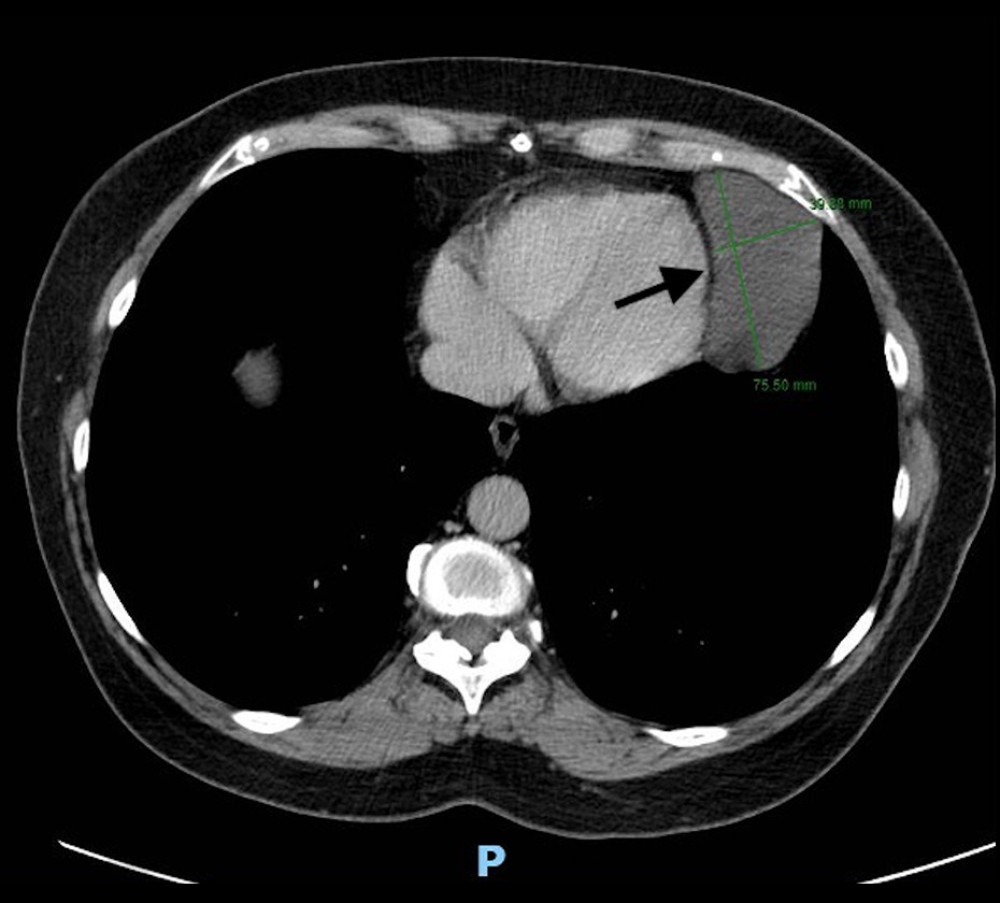 A CT scan was done, which confirmed the large cyst-like structure (cyst shown by arrow).