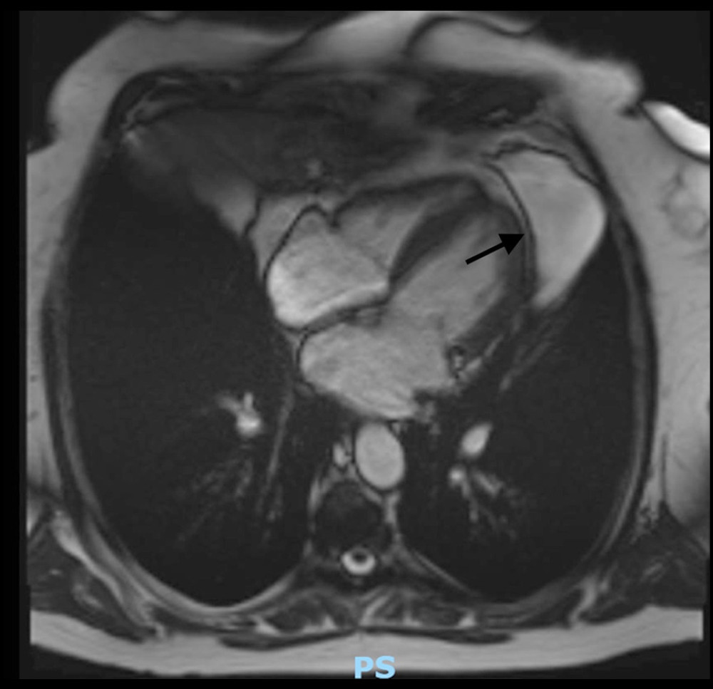 A cardiac MRI ascertained the presence of a large left-sided pericardial cyst with no communication with the pericardium (cyst shown by arrow).