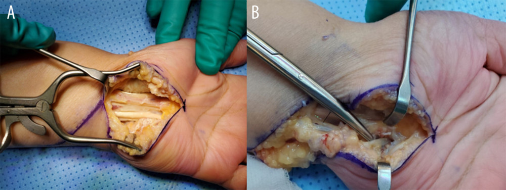 Median nerve (A) looks like a flat sheet after releasing fibrous tissue surrounding the nerve. The median nerve and ulnar nerve (B) were tightly adherent to the surrounding structures by tough fibrous tissue, preventing nerves from gliding.