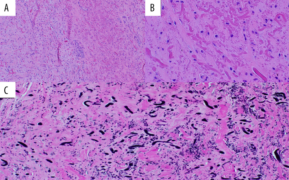 Elastofibroma of the hand. (A) collagen bundles alternating with refractive cylinders containing a central dense core (×100). (B) Higher magnification (×400). (C) Refractive cylinders are positive with elastic stain (×200).