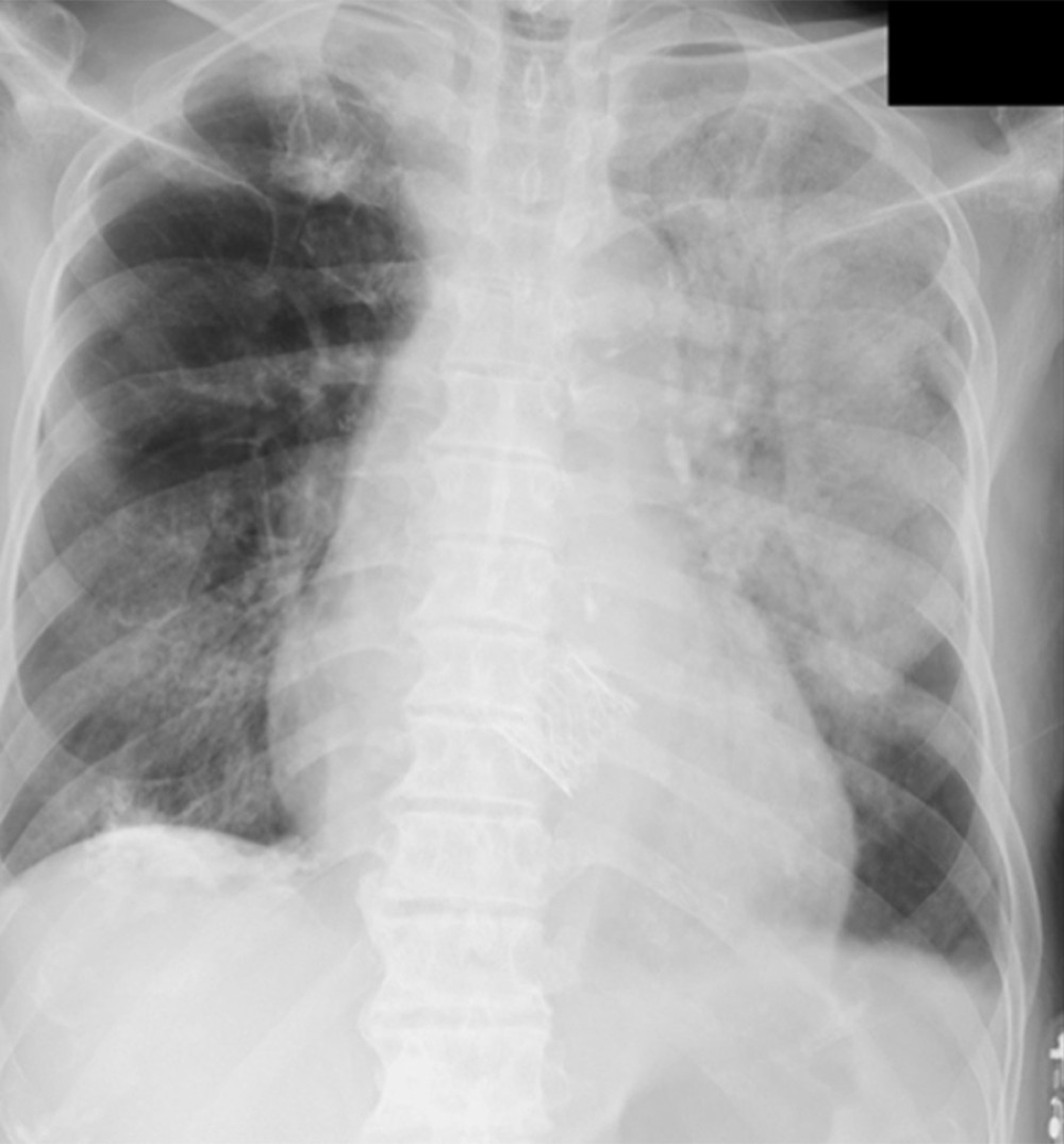 Chest radiography reveals infiltration in the left upper lung field and ground-glass opacity in the bilateral lower lung fields.