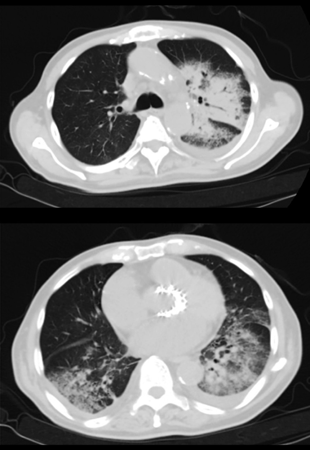 Chest computed tomography images are consistent with the findings from the chest radiograph.