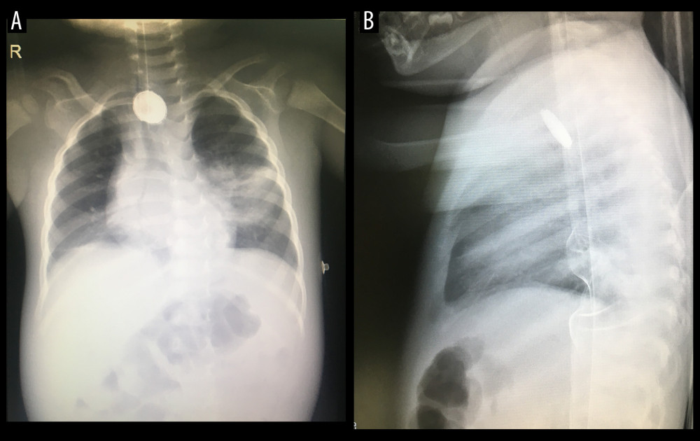 (A) Anteroposterior view, (B) lateral view of chest X-ray. showing rounded radiopaque button battery located at the upper esophagus at clavicles level with halo sign in anteroposterior view.