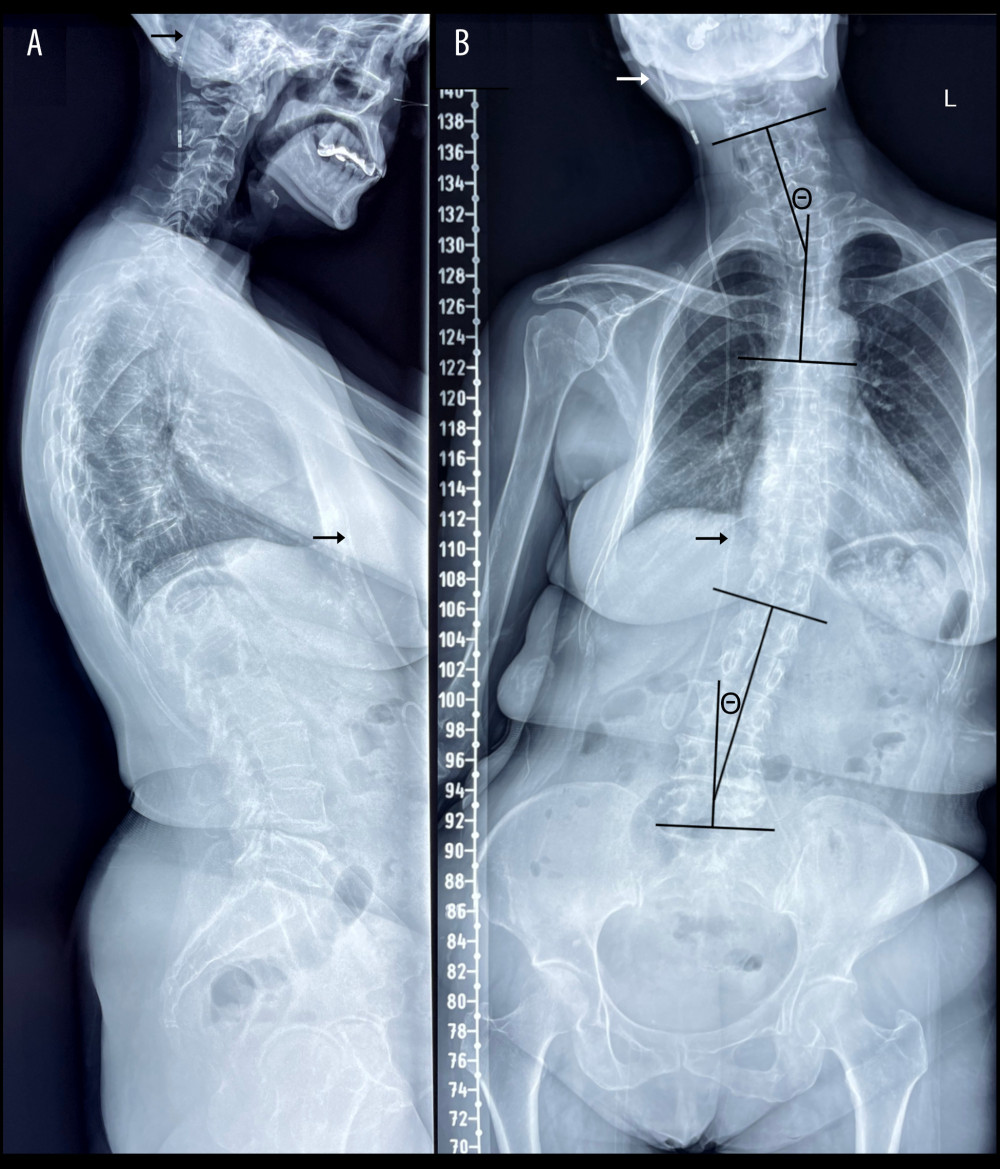 Full spine radiographs taken at an outside facility prior to presentation to the chiropractor. In the lateral view (A), the patient is noted to have an anterior head position with loss of the cervical lordosis. There is evidence of suboccipital craniectomy and laminectomy of C1 and C2. In the anteroposterior view (B), 3 scoliotic curvatures are evident, including a 20° levoconvex cervicothoracic curvature (upper Θ), a 20° dextroconvex lumbar curvature (lower Θ), and 13° levoconvex thoracic curvature (not shown).The visible span of the ventriculoperitoneal shunt appears intact in both views (arrows).