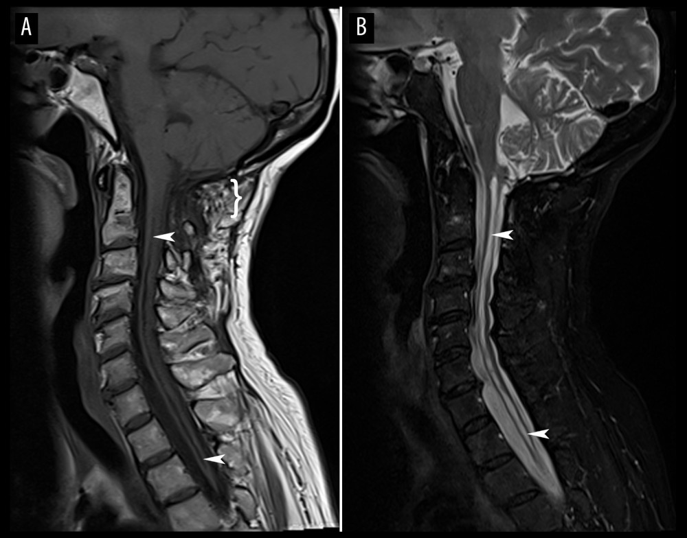 Sagittal cervical spine magnetic resonance imaging. Most evident on the T1-weighted image (A), bone defects are noted around the foramen magnum and posterior elements of C1 and C2 (bracket; }), suggestive of suboccipital craniectomy and laminectomy of C1 and C2. Also evident on the T1-weighted and T2-weighted image (B) is a spinal cord syrinx (arrowheads). At the lowermost extent of the image, the upper thoracic spinal canal is not visible, given the patient’s scoliotic curvature at this region.