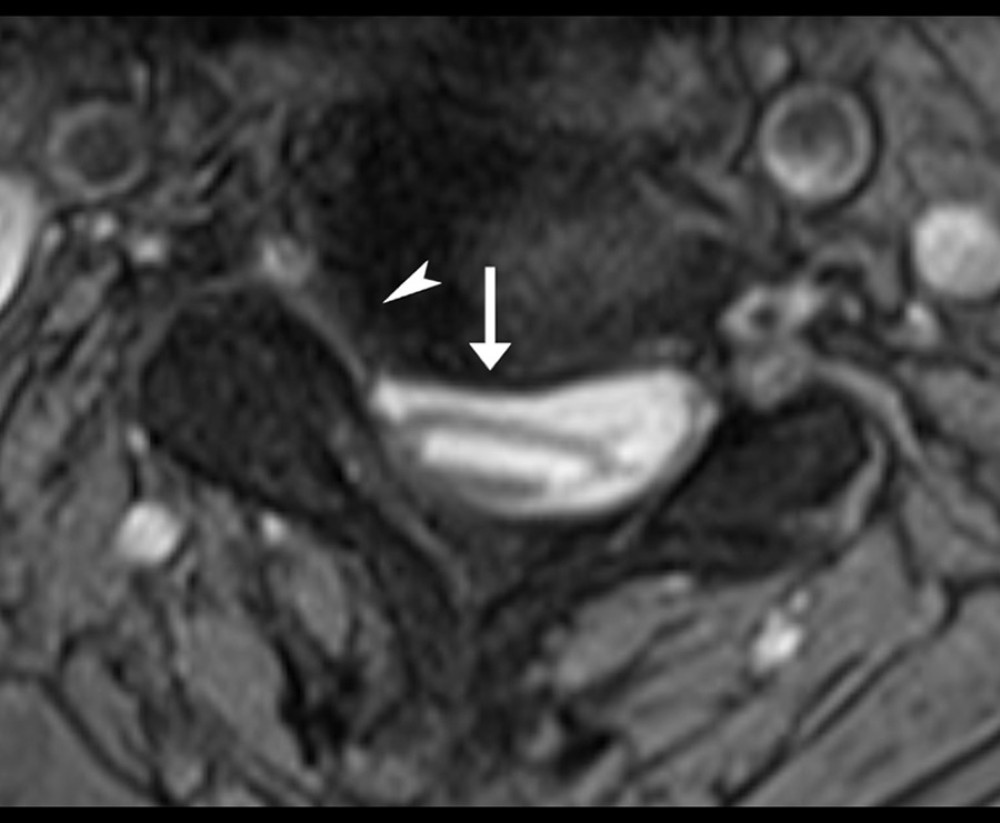 Axial T2-weighted cervical magnetic resonance image at C4/5. There is moderate narrowing of the central canal due to an eccentric disc osteophyte complex on the right (arrow). There is also moderate narrowing of the right neural foramen due to disc herniation (arrowhead).