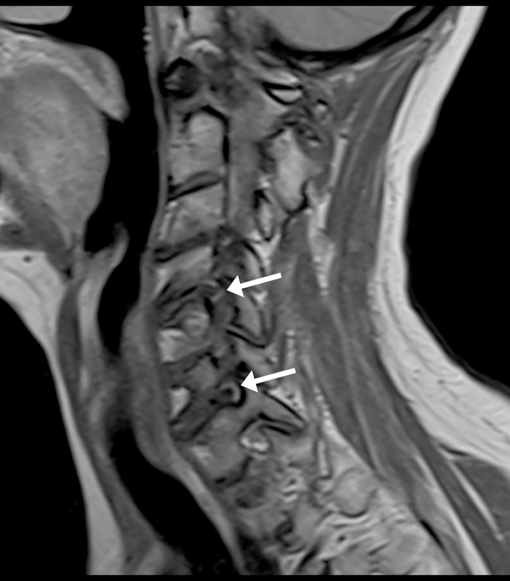 Right oblique sagittal proton density turbo spin echo cervical magnetic resonance image. Moderate narrowing of the right C4/5 and C6/7 neural foramina due to disc herniation is evident (arrows).
