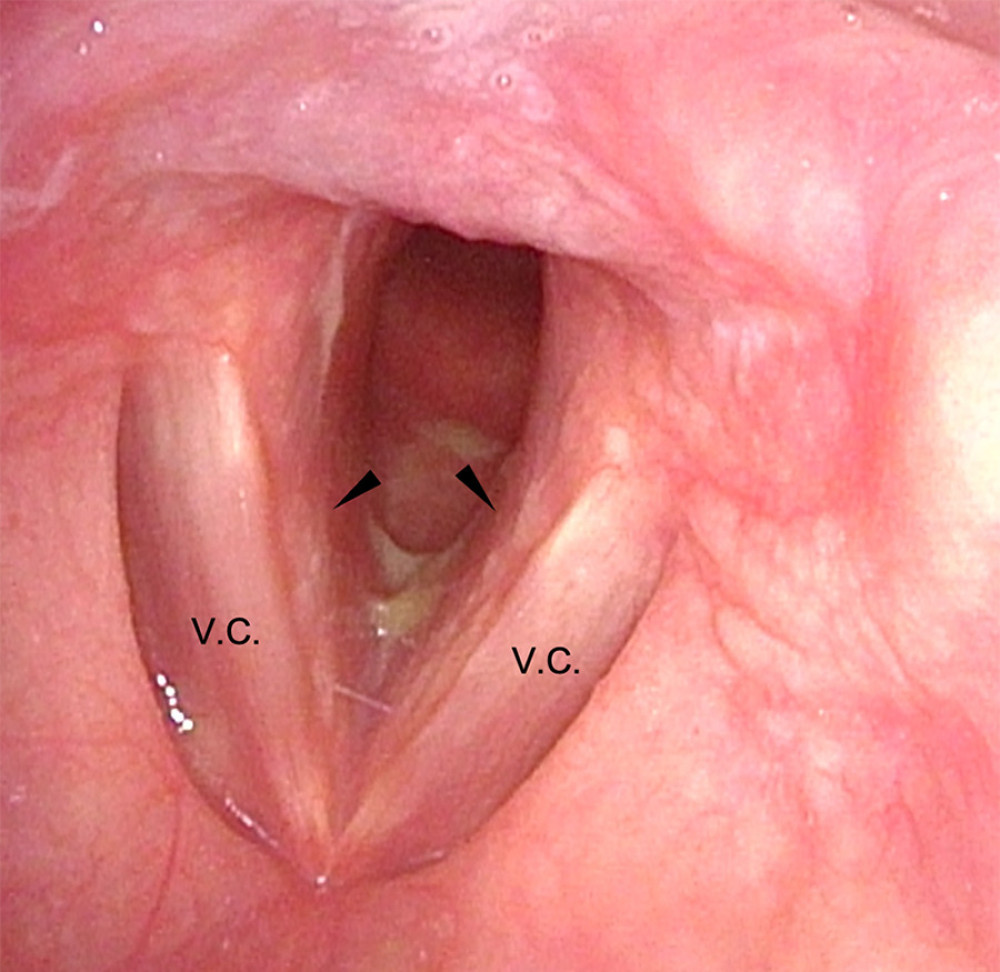 Image of the larynx on arrival. Edema was found under the vocal cords (arrowheads). V.C. – vocal cords.
