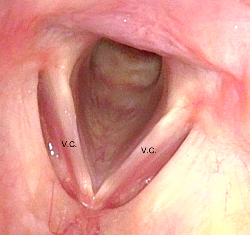 Image of the larynx 24 days after discharge (34 days after arrival). Edema was improved by administration of prednisolone. V.C. – vocal cords.