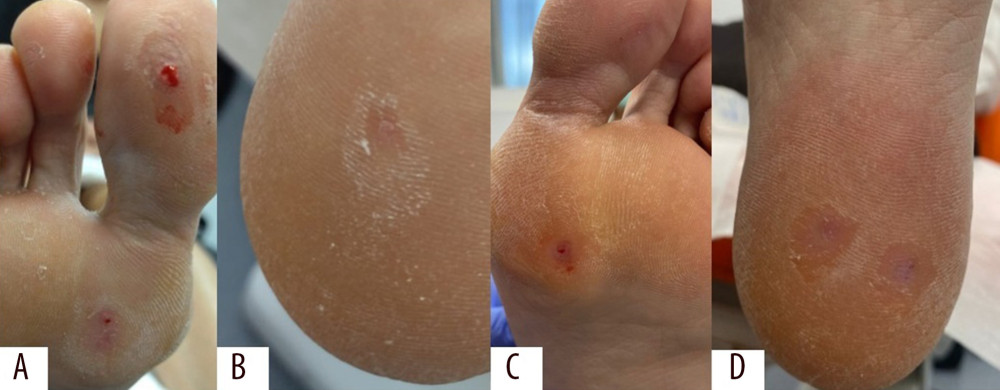 Plantar warts at visit 1. (A) Ball of the hallux, ball of the second toe, and first metatarsal head of the right foot. (B) Heel of the right foot. (C) First metatarsal head of the left foot. (D) Heel of the left foot.
