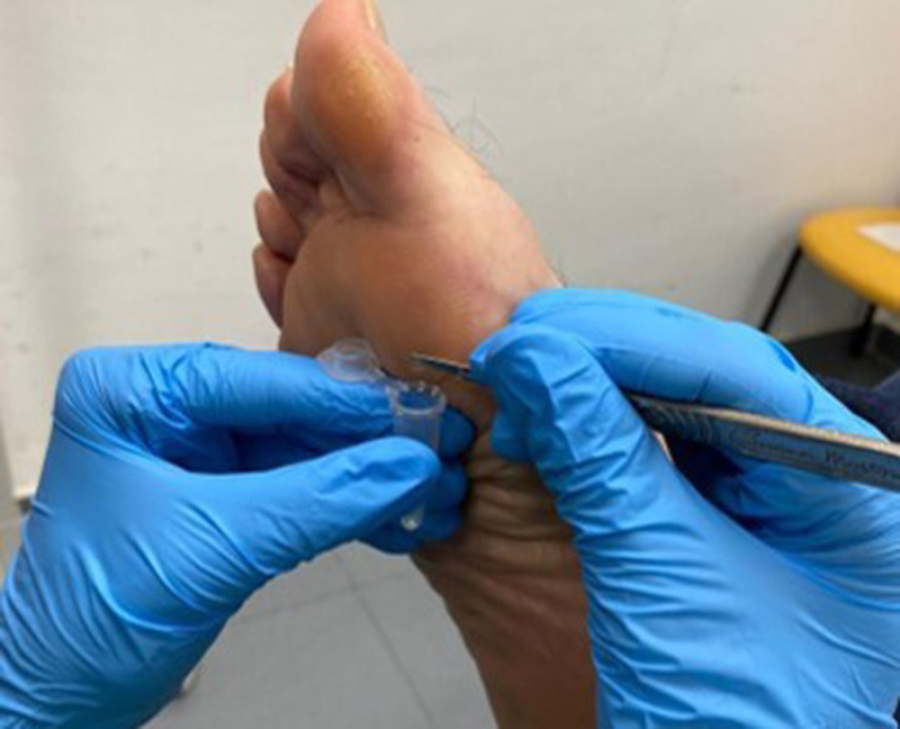 American Journal of Case Reports CantharidinPodophyllinSalicylic