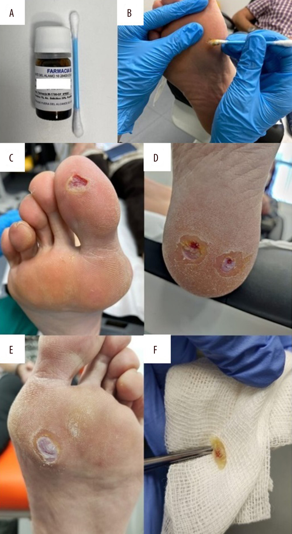 Treatment for plantar wart with cantharidin-podophyllin-salicylic acid (CPS) formulation. (A, B) Application by swabbing the entire surface of the plantar wart. (C) Ball of the hallux of the right foot after 2 days of application. (D) Heel of the left foot after 2 days of application. (E) First metatarsal head of the left foot after 1 day of application. (F) Plantar wart removed.