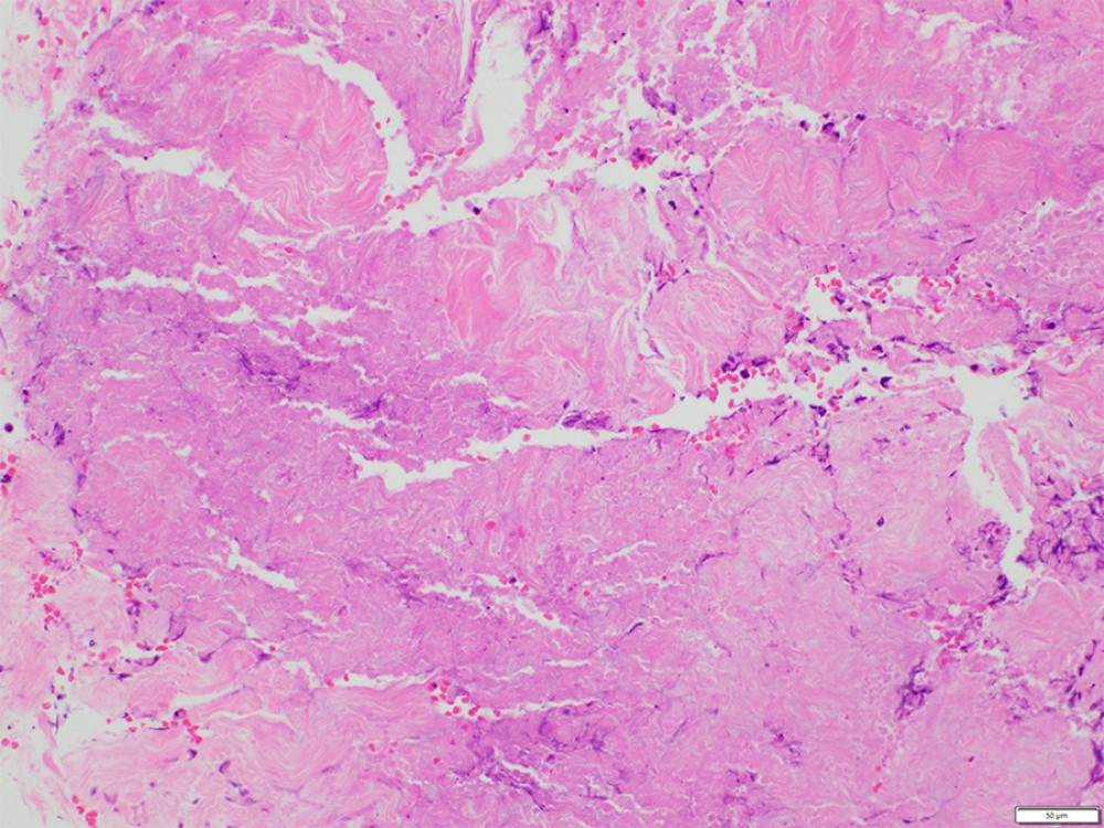 The left external oblique fascia. Hematoxylin and eosin staining reveals mostly necrosis, with some infiltration of neutrophils.