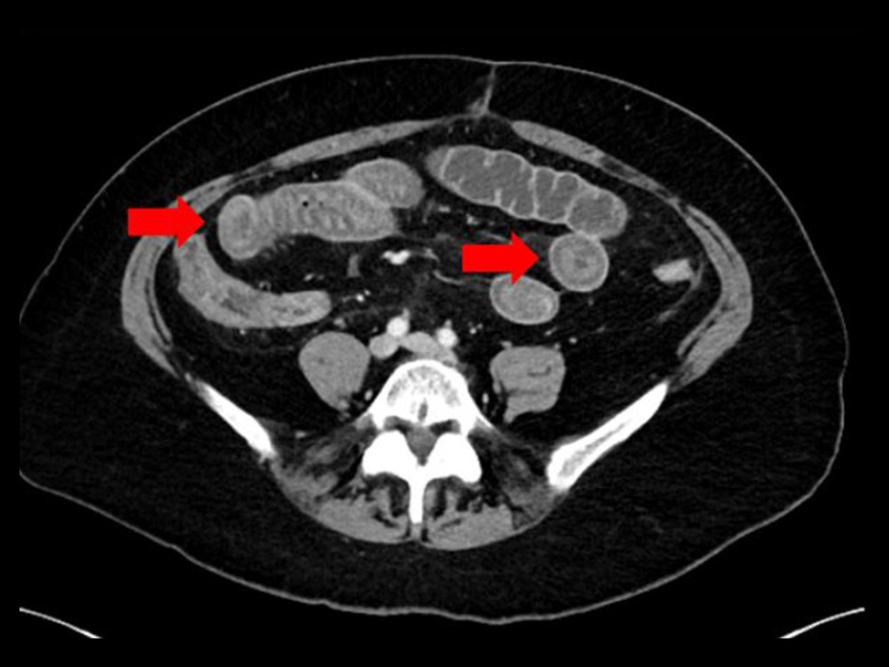 Radiologic computed tomography imaging revealed diffuse edematous thickening of multiple distal small bowel loops, with associated edema of the small bowel mesentery.