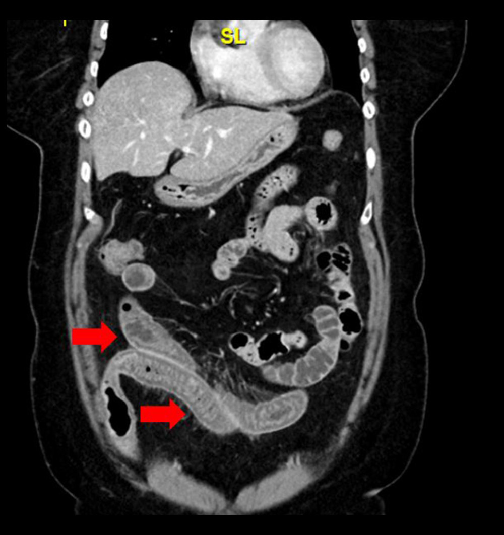 Coronal imaging reveals edema of the bowel and its mesentery.