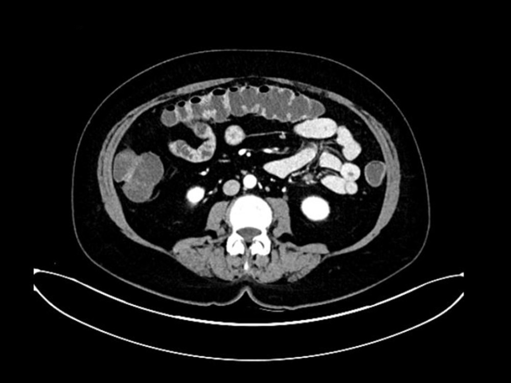 Three-month follow-up imaging shows the resolution of edema.