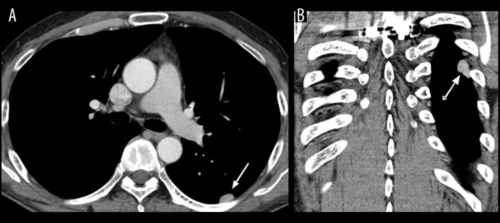 Coronal (A) and sagittal (B) chest CT revealing 1-cm focal pleural thickening in left pleura (arrows).