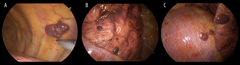 A soft, well-circumscribed, red mass was identified on the chest wall (A). Multiple soft, red nodules were diffusely distributed on the surface of the lung and diaphragm (B, C).