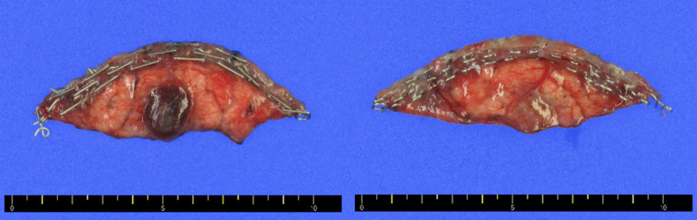 The specimen from a wedge resection of the left lower lobe of the lung, measuring 2.7×0.8×0.4 cm. The nodule was 0.5 cm, with a well-demarcated oval shape. Each interval of the scale indicates 0.3 cm, and the power of magnification is 1: 0.3.