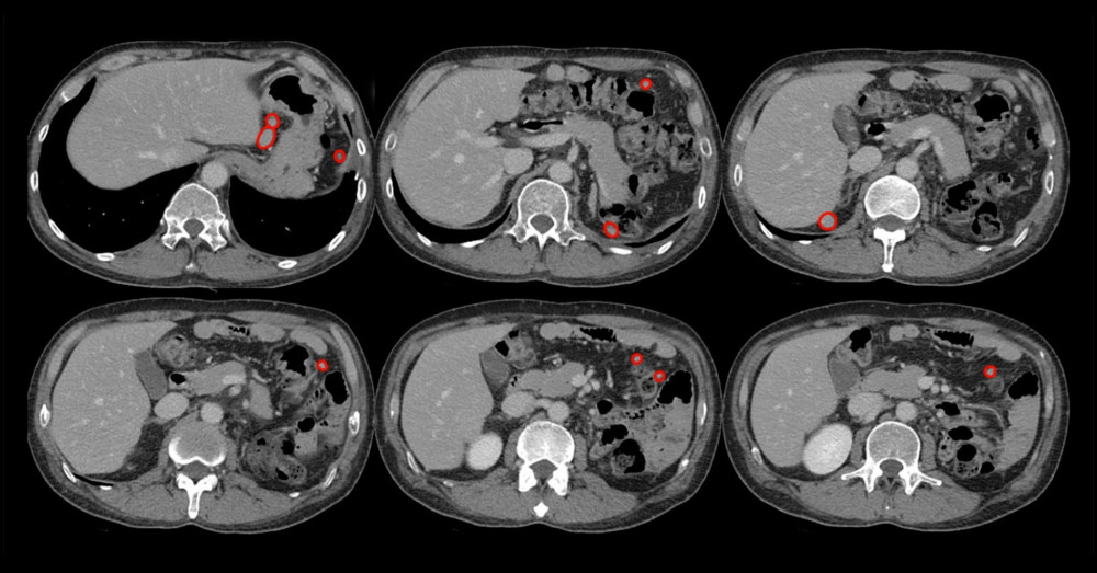 Abdominopelvic CT showing multiple soft-tissue lesions caused by the previous splenectomy. Several well-enhanced, soft-tissue lesions up to 2.6 cm in size were found in the left upper abdomen, right posterior subphrenic space, and right pelvic cavity (circled in red).