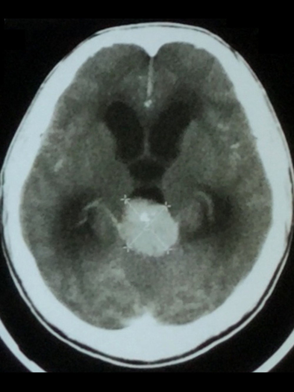 Computed tomography of brain, coronal section with contrast, 25 years prior to presentation. A 3.2×3.7-centimeter soft-tissue mass lesion with a central focus of calcification is noted in the pineal region. The mass bulges into the posterior aspect of the 3rd ventricle, resulting in obstructive hydrocephalus with moderate-to-severe dilation of the 3rd and lateral ventricles. The lesion homogenously enhanced with contrast.