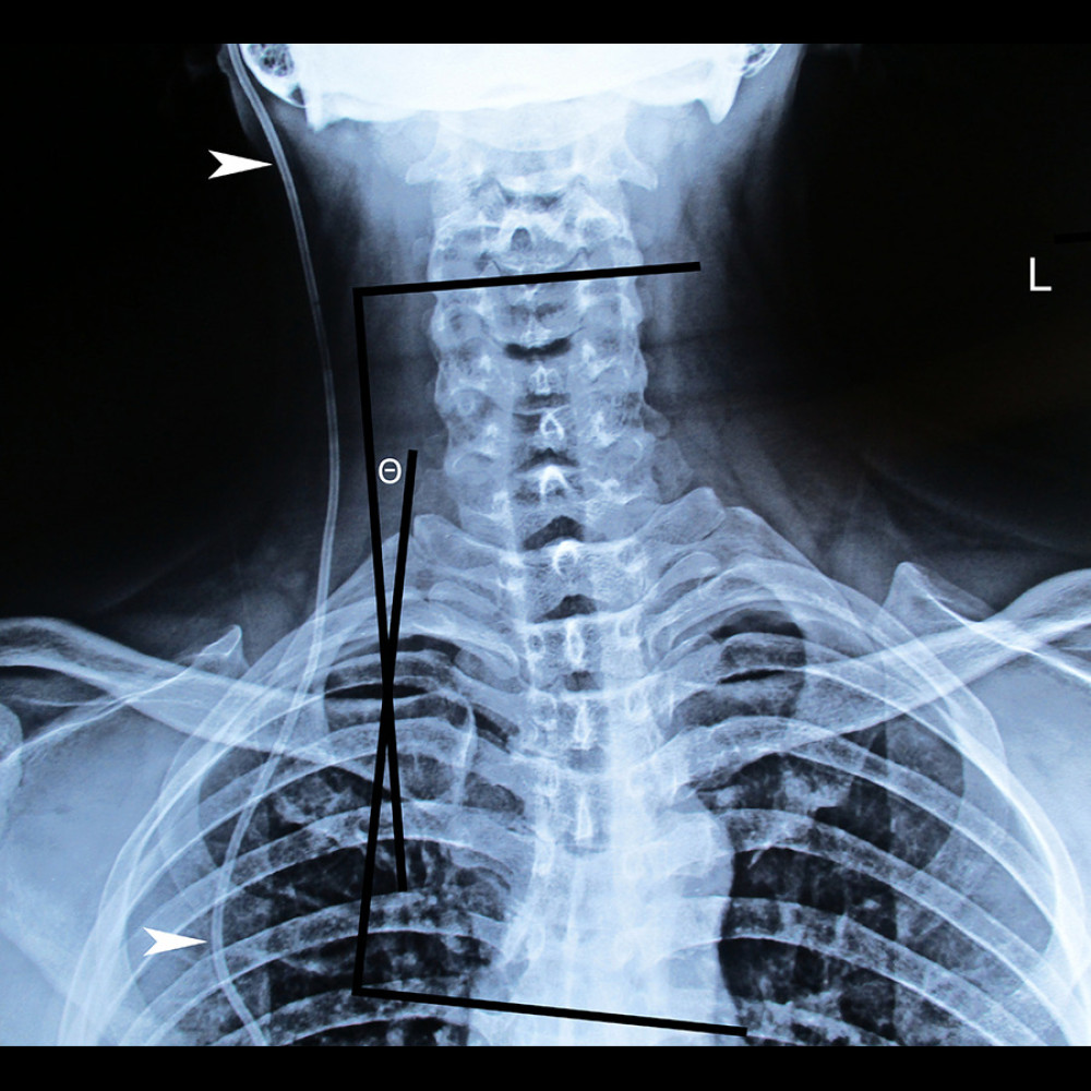 Anteroposterior cervical spine radiograph. The patient’s cervical spine is deviated to the right side of the midline, and a levoconvex cervicothoracic scoliosis is evident, extending from C4 to T6, measuring 11° (θ). A radiopaque ventriculoperitoneal shunt is also noted on the patient’s right side (arrowheads).