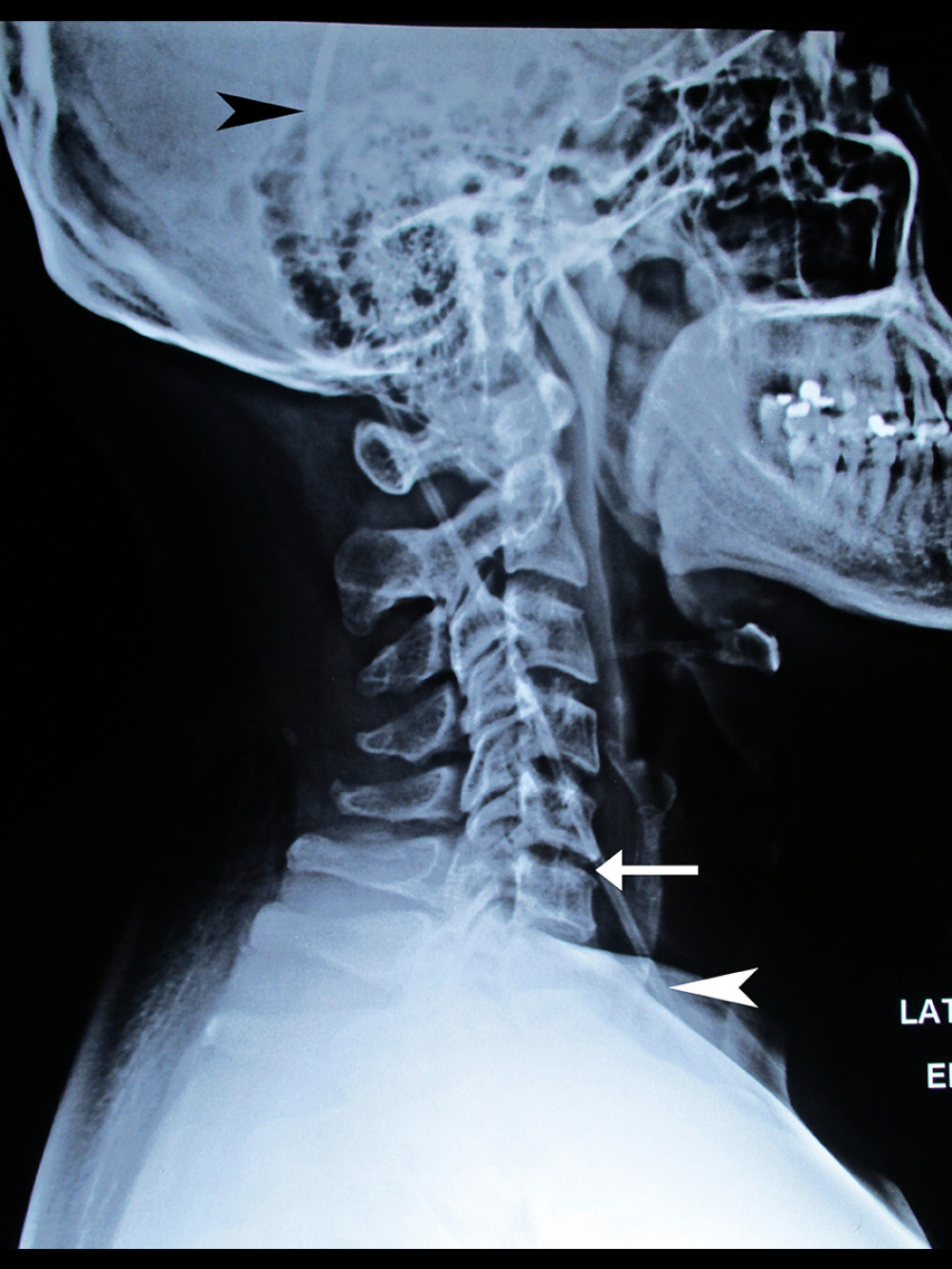 Lateral cervical spine radiograph. The cervical lordosis is visibly reduced (straightened cervical curve), and there is mild disc space narrowing at C5–6 (arrow). The ventriculoperitoneal shunt is also evident (arrowheads).