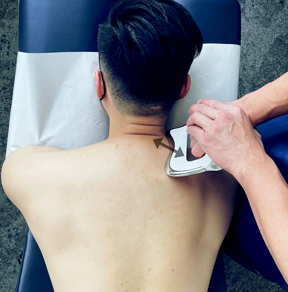 Instrument-assisted soft-tissue manipulation. The chiropractor applies a thin layer of emollient and gently strokes a massage tool with a beveled edge against the targeted muscle groups (arrows). Treatment of the upper trapezius is shown.