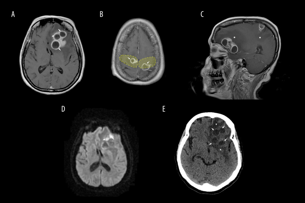 T1-weighted magnetic resonance imaging of brain after gadolinium administration revealed multiple ring-enhancing lesions. (A) Axial view showing multi-compartment left frontal lesions (arrows) measuring 4.6×3.8×3.2 cm with mass effect. (B) Axial view showing left and right fronto-parietal lesions measuring 1.2×2.2×3 cm and 1.6×1.3×1.5 cm, respectively, (arrows) in close proximity to an eloquent area (primary motor cortex is located within the yellow highlighted box). (C) Sagittal view demonstrating the lesions surrounded by extensive vasogenic edema (asteriks). (D) Diffusion-weighted imaging showing diffusion restriction as indicated by the hyperintensity (arrows). (E) Non-contrast computed tomography of brain showing several hypodense round lesions in the left frontal region (arrows) with well-defined hyperdense ring, surrounded by edema (asteriks), causing mass effect and effacement of the anterior horn of left lateral ventricle.