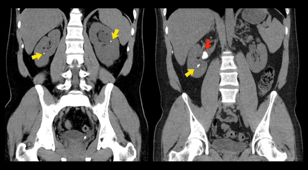 Preoperative computed tomography scan showing bilateral kidney stones (yellow arrows) and larger right renal calculi (red arrow).