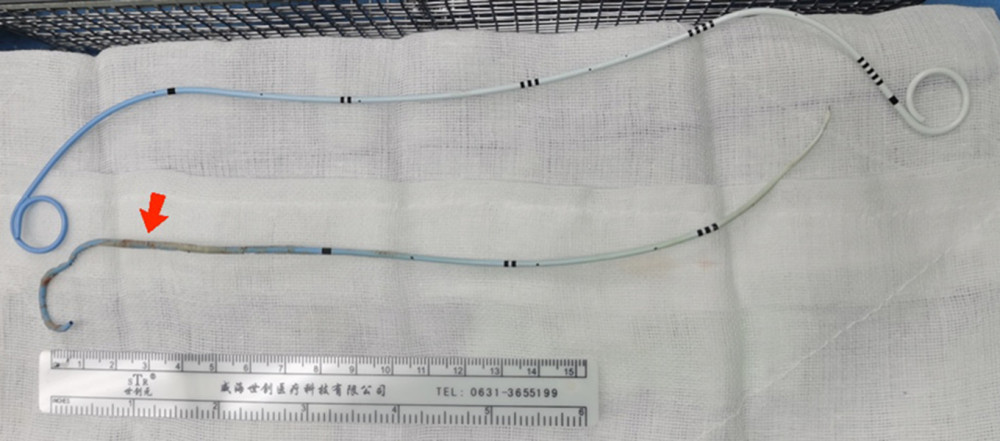 A normal Polaris Ultra ureteral stent (upper) versus a fragmented Polaris Ultra ureteral stent with calcifications (red arrow).