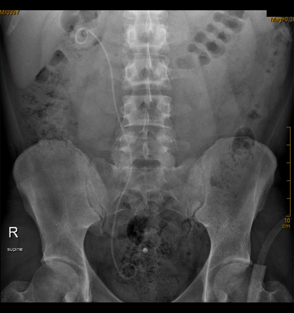 Follow-up second postoperative X-ray showing the intact right ureteral stent prior to successful extraction.
