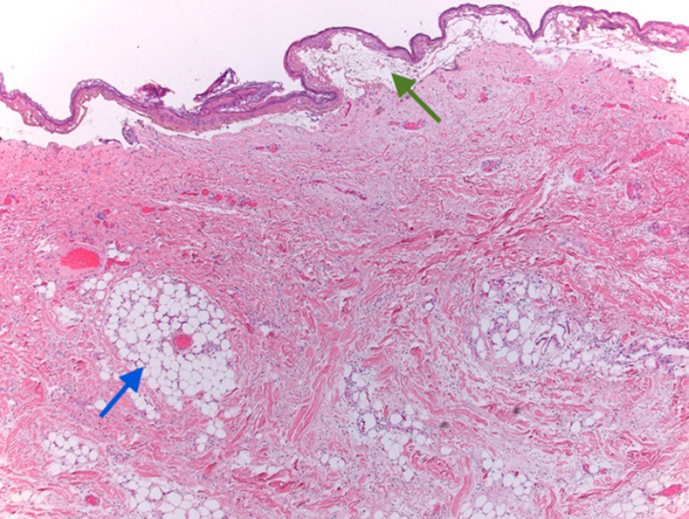 American Journal of Case Reports Nevus Lipomatosus Superficialis in a