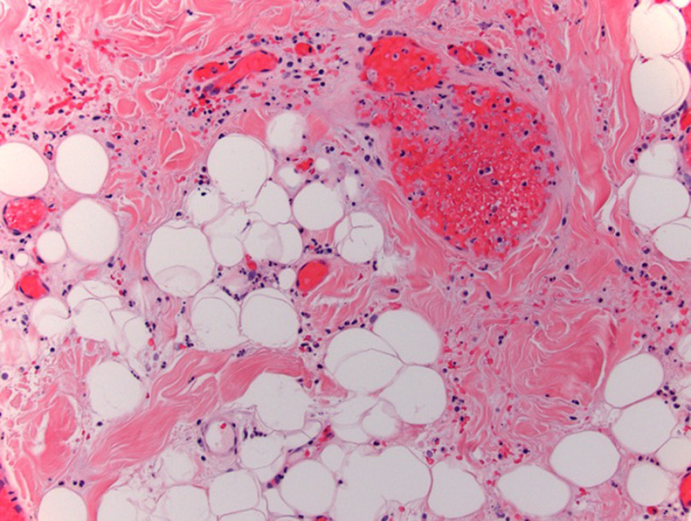 Histology shows lymphocytes dispersed across the stroma and surrounding vessels within the dermis (200×).