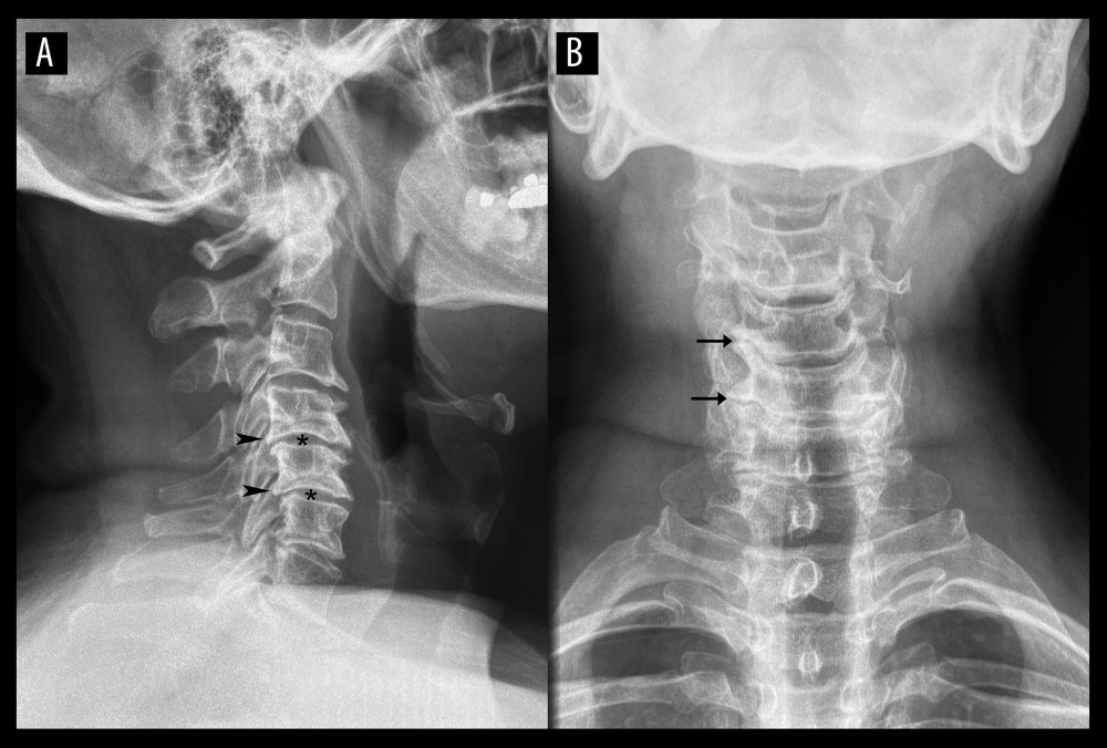 Cervical spine radiographs. Lateral view (A) and anteroposterior view (B). Degenerative changes are noted in the mid-to-lower cervical spine including posterior vertebral body osteophytes (arrowheads), disc space narrowing (*), and uncovertebral joint degeneration (arrows). In addition, the cervical lordosis is reduced as the neck is visibly straightened, and has a slight kyphosis at C3/4.
