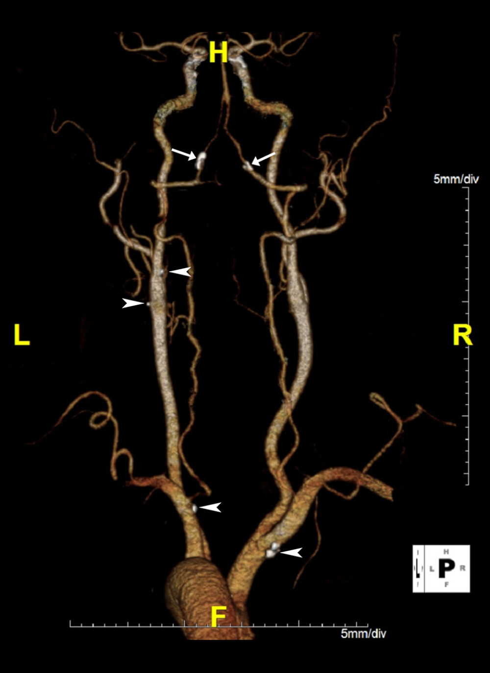 Computed tomography angiogram of neck, 3D volume-rendered image. Orientation: left (L), right (R), head (H), feet (F). Calcified plaques of the vertebral arteries are evident bilaterally (arrows), more prominently on the left than right. From superior to inferior, additional smaller calcified plaques are easily visible at the left carotid bulb (×2), left subclavian artery, and right brachiocephalic trunk (arrowheads).