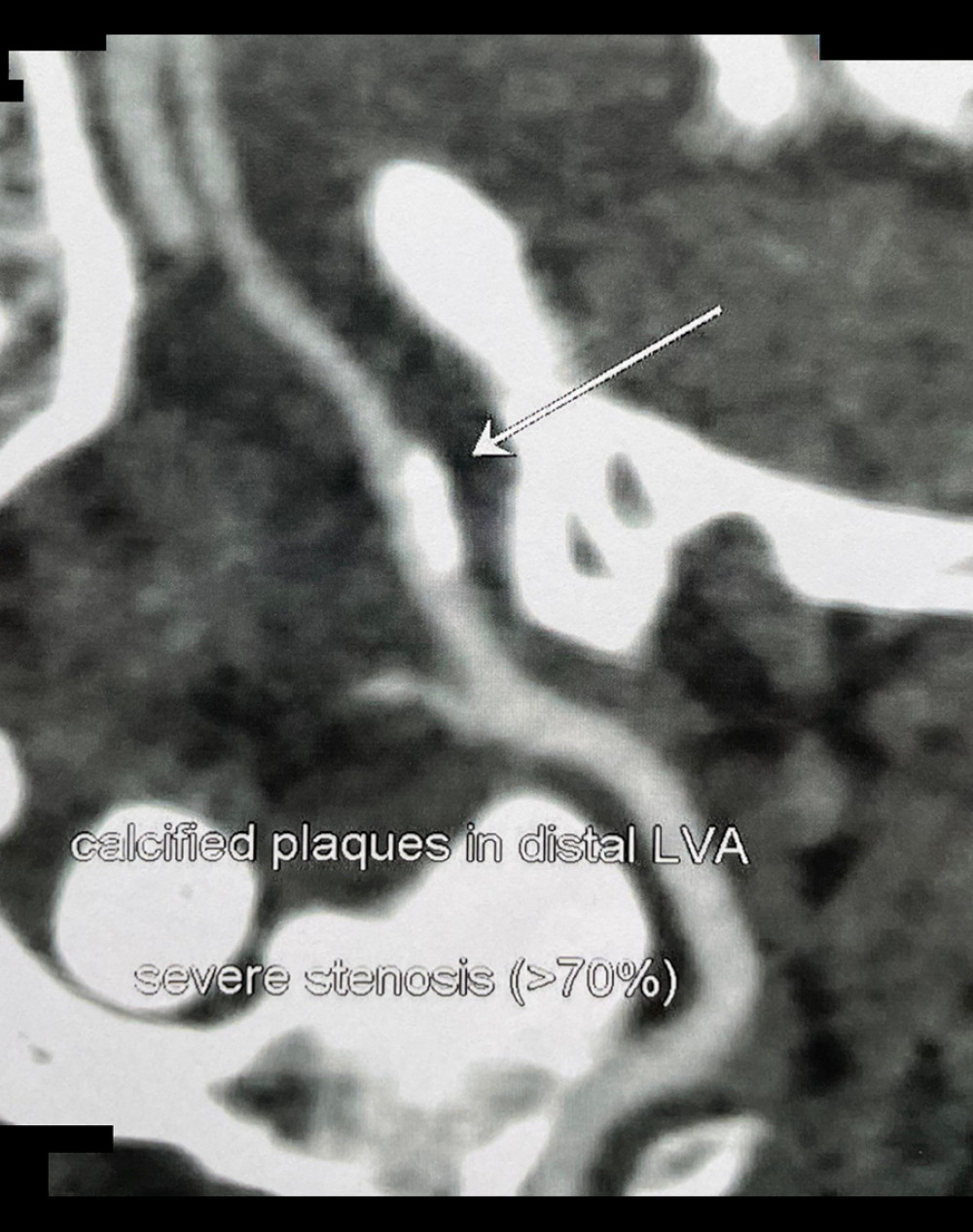 Oblique computed tomography angiogram of the head showing calcified plaque of the left vertebral artery (LVA) at the transition between the V3 and V4 segment of the right vertebral artery RVA (arrow).