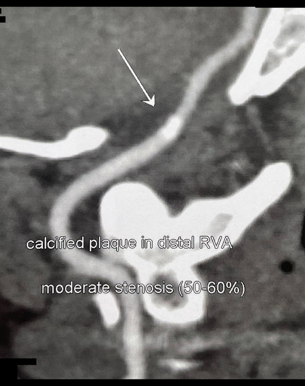 Oblique computed tomography angiogram of the head showing calcified plaque of the right vertebral artery (RVA) at the transition between the V3 and V4 segment of the RVA (arrow).