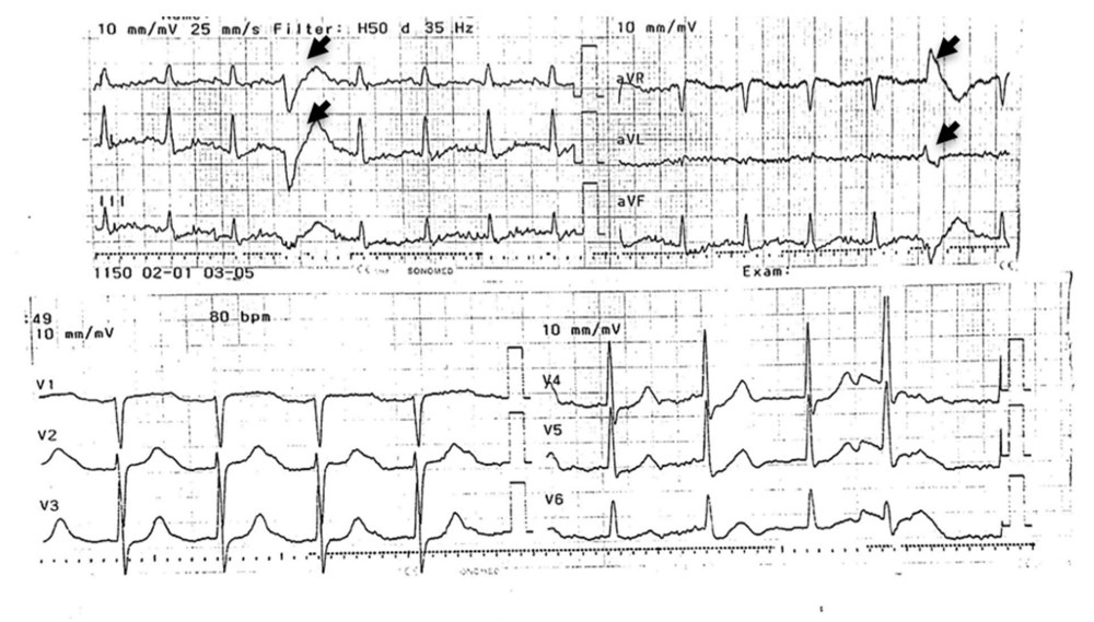 Electrocardiogram of the patient at the time she was admitted to the Emergency Department after the first cardiac arrest. The 12-lead electrocardiogram revealed sinus tachycardia with premature ventricular complexes (arrow).