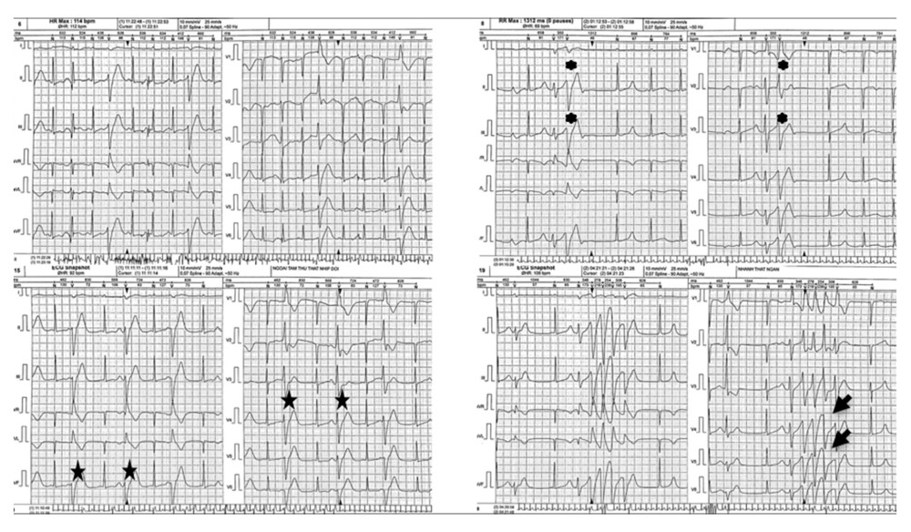 Holter electrocardiogram of the patient demonstrated sinus rhythm with short PR interval, prolonged QTc, multifocal premature ventricular complexes, bigeminy (star), couplets (asterisk), and non-sustained ventricular tachycardia (arrow).